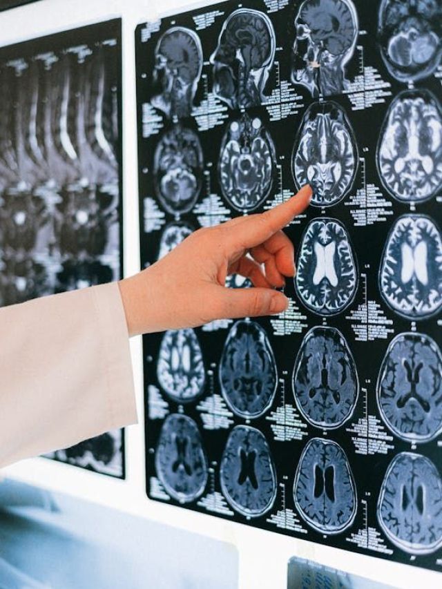 O que é hemorragia intracraniana e quais são as causas? Entenda